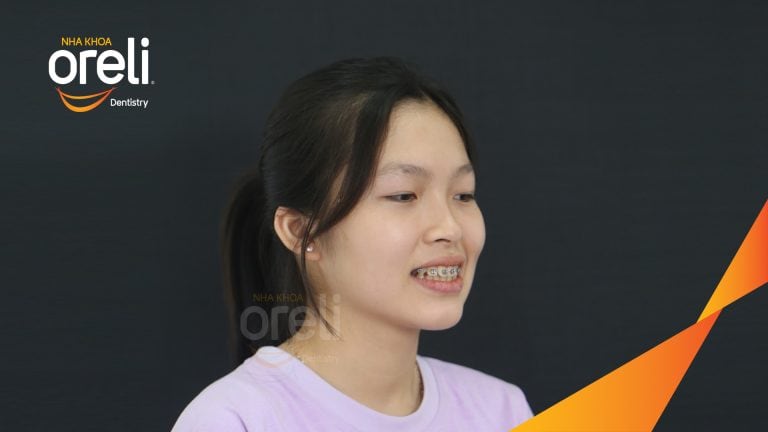 Trước – Sau niềng răng hô: Thay đổi rõ sau 24 tháng tại nha khoa Oreli