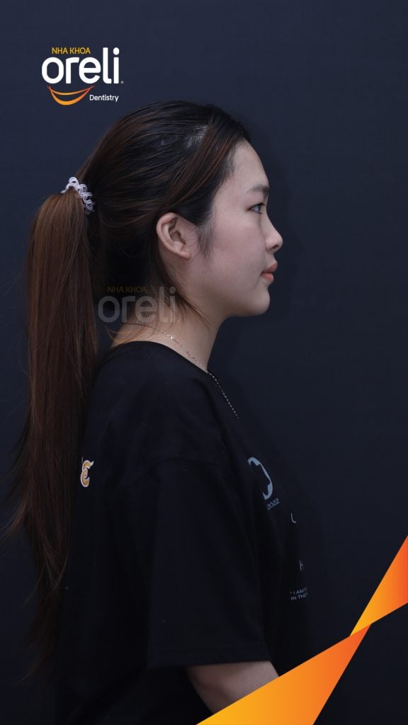 Thực hiện Nhổ răng 4 chỉnh hô kéo dài 24 tháng tại Nha khoa Oreli