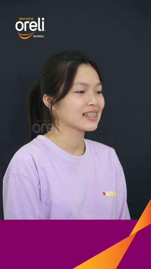 Kết quả sau 24 tháng: Nụ cười hài hòa, mặt nghiêng đẹp, trục răng cửa đứng tại Nha khoa Oreli