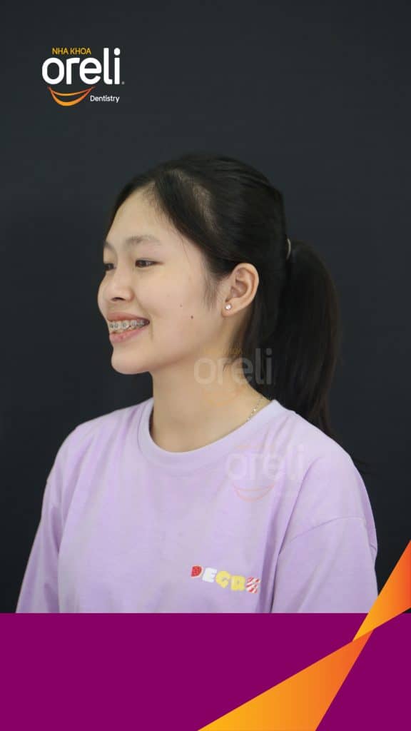 Trước điều trị: Nhô xương ổ, trục răng nghiêng trước hai hàm, độ nhô môi nhiều tại Nha khoa Oreli