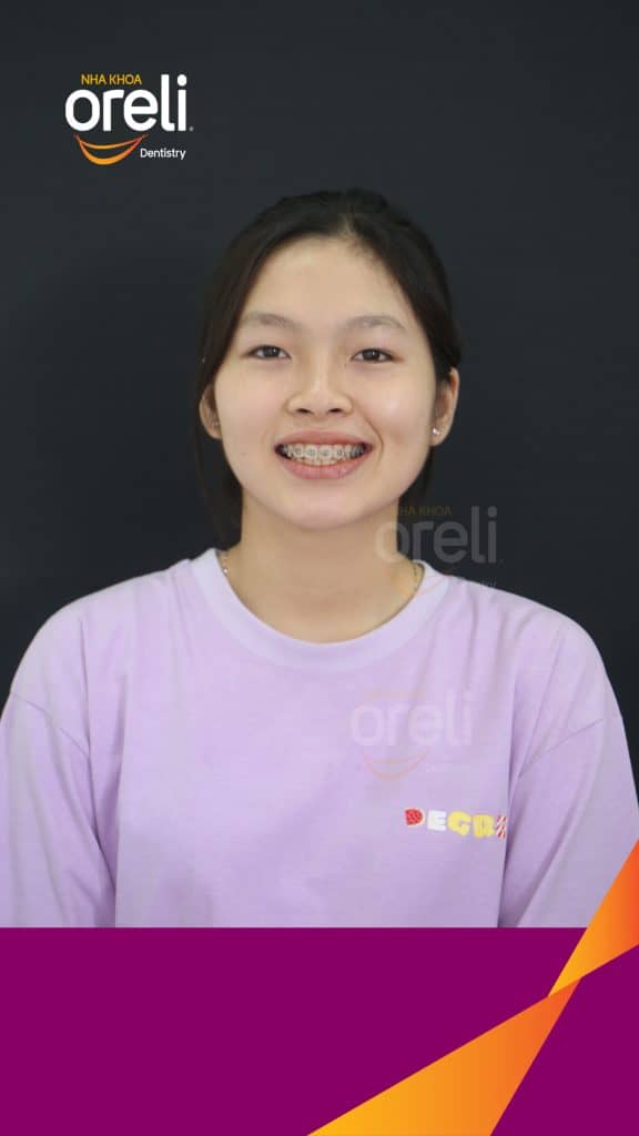 Quá trình Nhổ răng 4 chỉnh hô trong 24 tháng tại Nha khoa Oreli