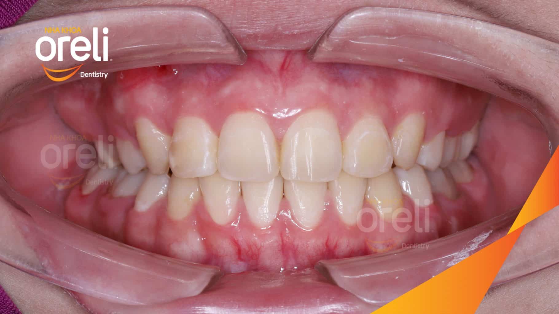 Thực hiện Nhổ răng 4 chỉnh hô kéo dài 24 tháng tại Nha khoa Oreli