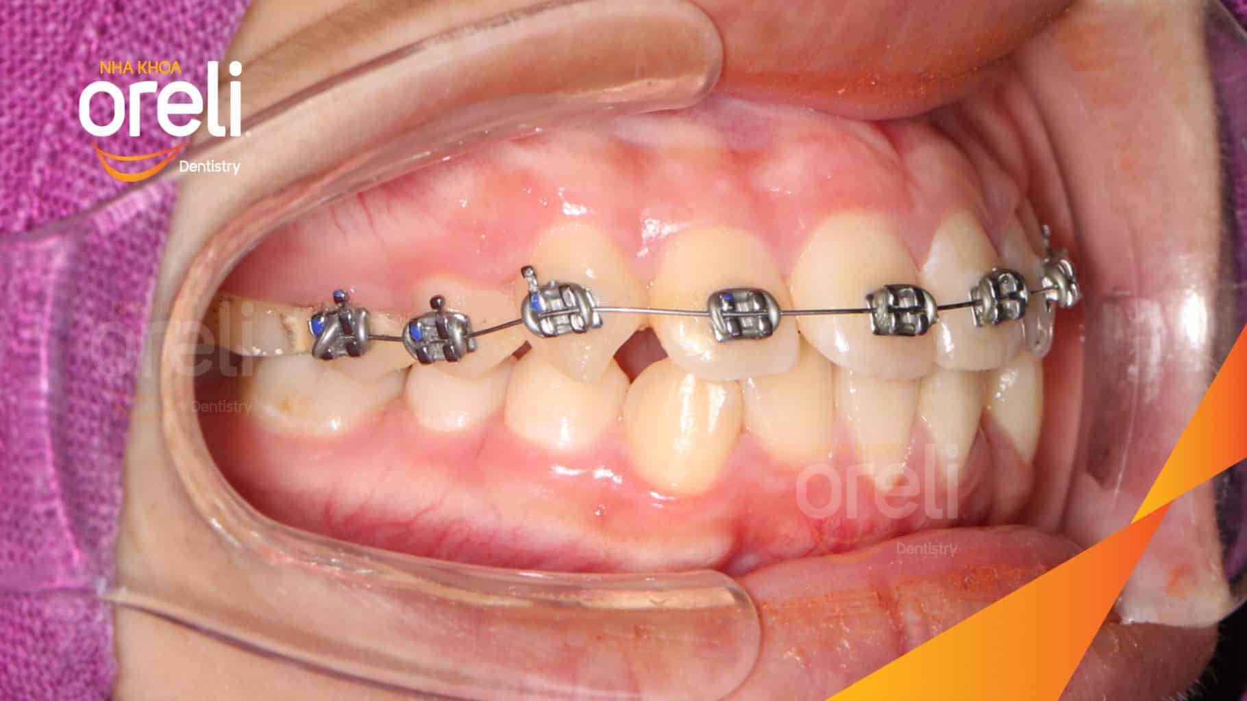 Kết quả sau 24 tháng: Nụ cười hài hòa, mặt nghiêng đẹp, trục răng cửa đứng tại Nha khoa Oreli