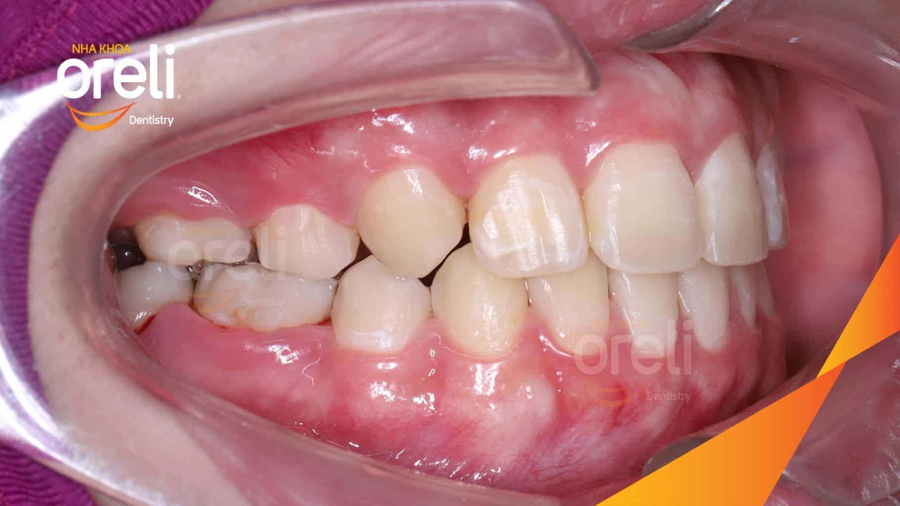 Kết quả đạt được sau 24 tháng - Nụ cười hài hòa, mặt nghiêng đẹp, trục răng cửa đứng tại Nha khoa Oreli