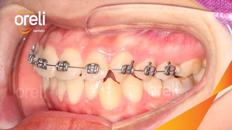 Trước – Sau niềng răng hô: Thay đổi rõ sau 24 tháng tại nha khoa Oreli