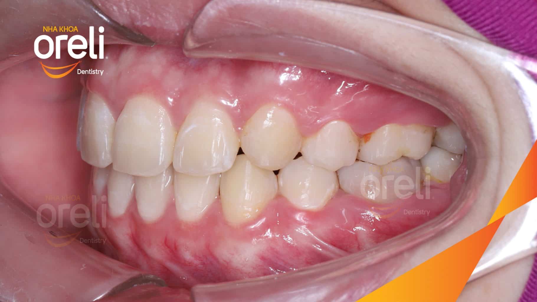 Nhô xương ổ, trục răng nghiêng trước hai hàm, độ nhô môi nhiều trước khi điều trị tại Nha khoa Oreli