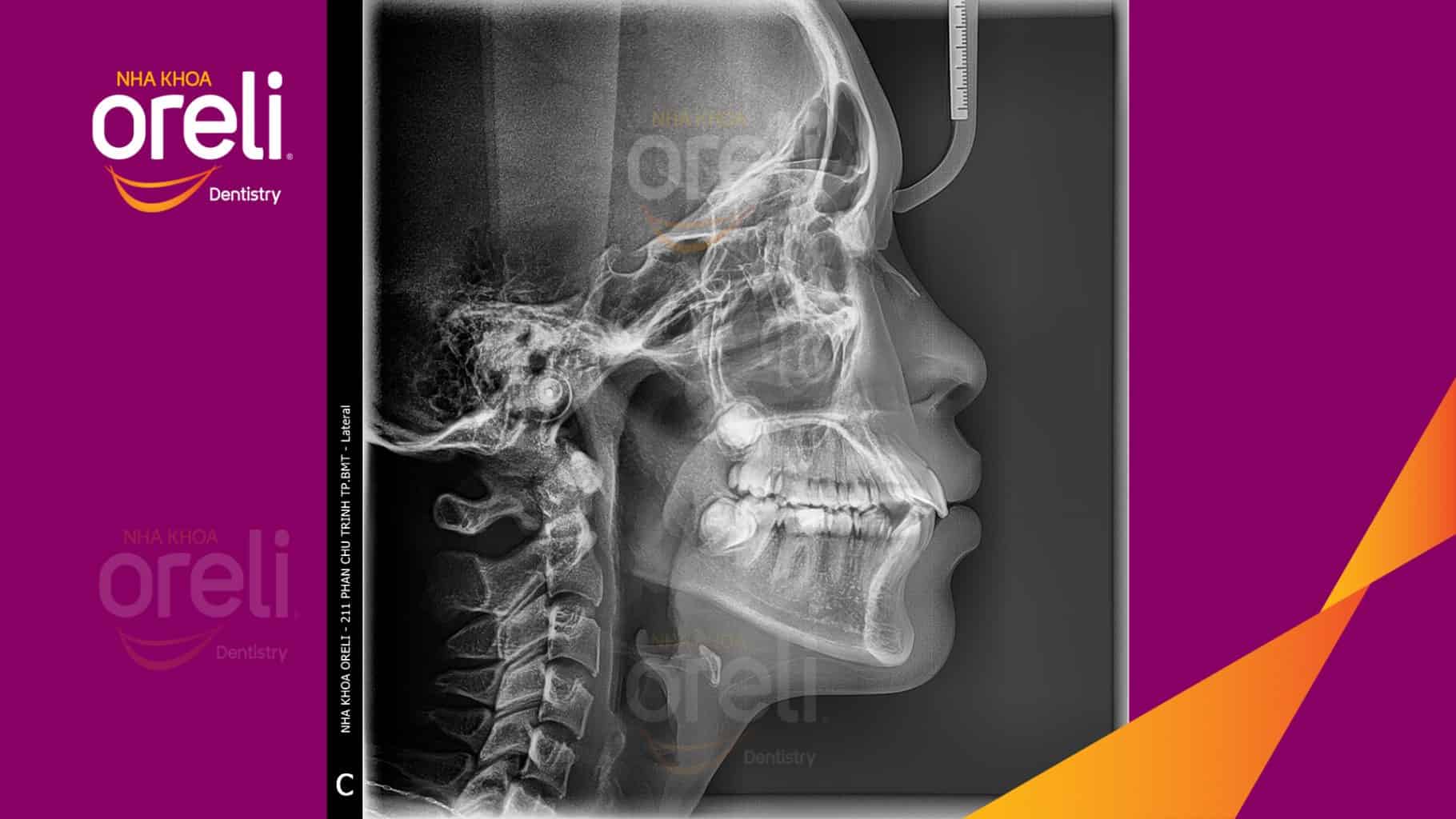 Trước điều trị: Nhô xương ổ, trục răng nghiêng trước hai hàm, độ nhô môi nhiều tại Nha khoa Oreli