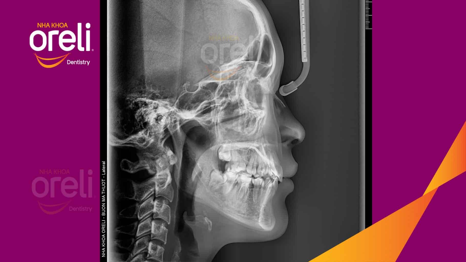 Nhô xương ổ, trục răng nghiêng trước hai hàm, độ nhô môi nhiều trước khi điều trị tại Nha khoa Oreli