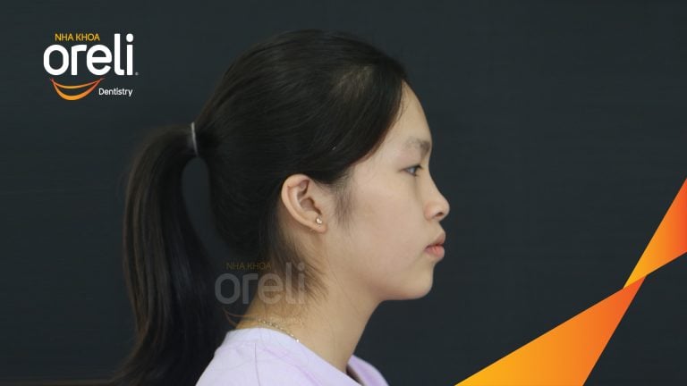 Trước – Sau niềng răng hô: Thay đổi rõ sau 24 tháng tại nha khoa Oreli