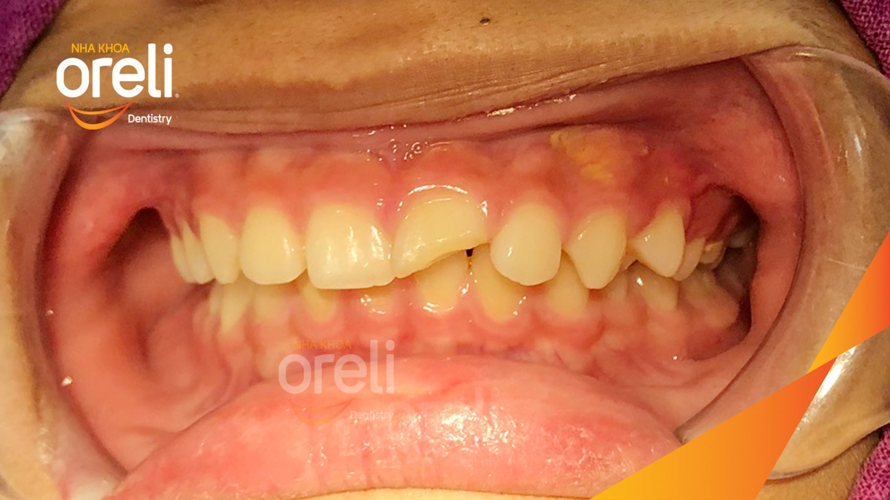 Kết quả sau 3 năm: Trục răng cửa thẳng đẹp, khớp cắn đúng tại Nha khoa Oreli
