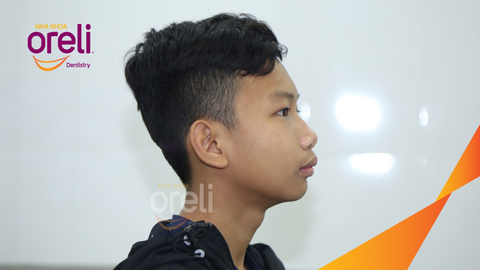 Thực hiện Niềng răng mắc cài, không nhổ răng nắn chỉnh khớp cắn  kéo dài 3 năm tại Nha khoa Oreli
