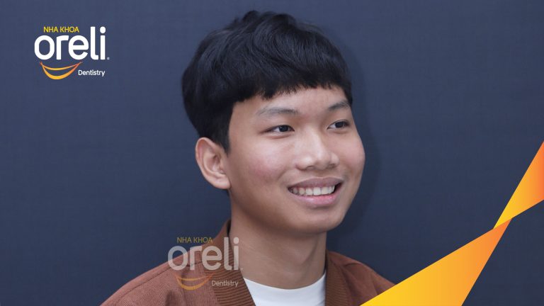 Niềng chỉnh hô không nhổ răng kết quả thực tế tại Oreli