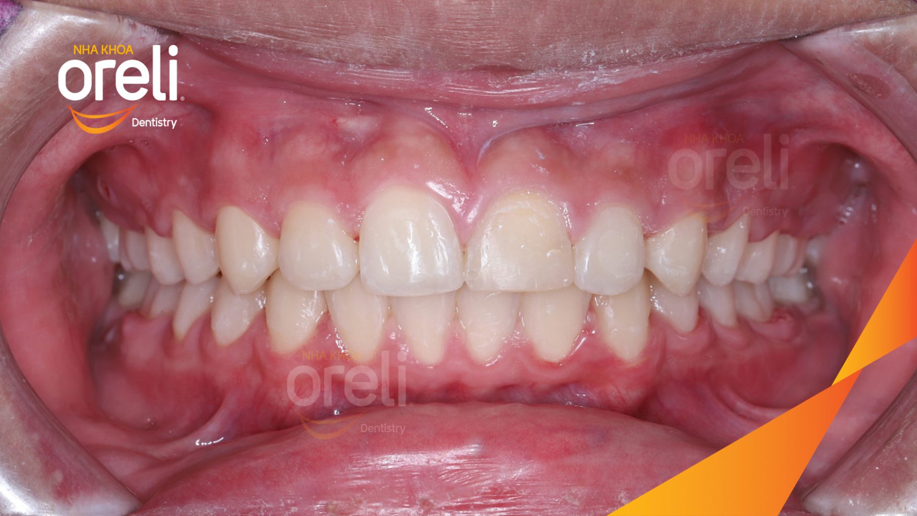 Kết quả đạt được sau 3 năm - Trục răng cửa thẳng đẹp, khớp cắn đúng tại Nha khoa Oreli