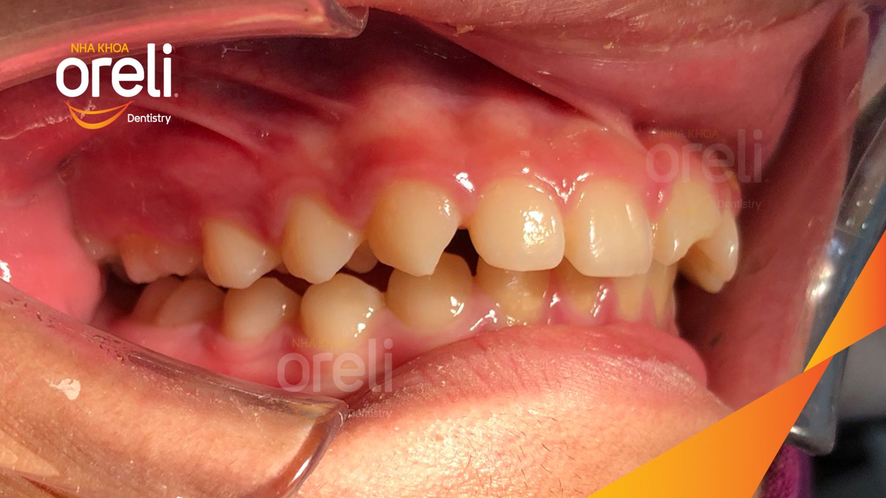 Quá trình Niềng răng mắc cài, không nhổ răng nắn chỉnh khớp cắn  trong 3 năm tại Nha khoa Oreli