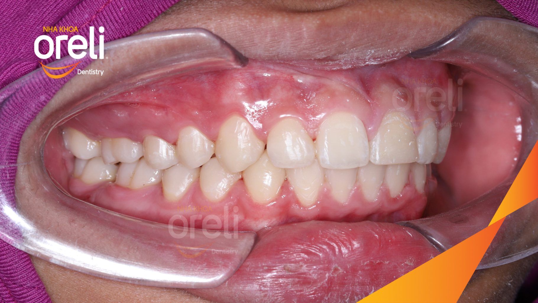Thực hiện Niềng răng mắc cài, không nhổ răng nắn chỉnh khớp cắn  kéo dài 3 năm tại Nha khoa Oreli