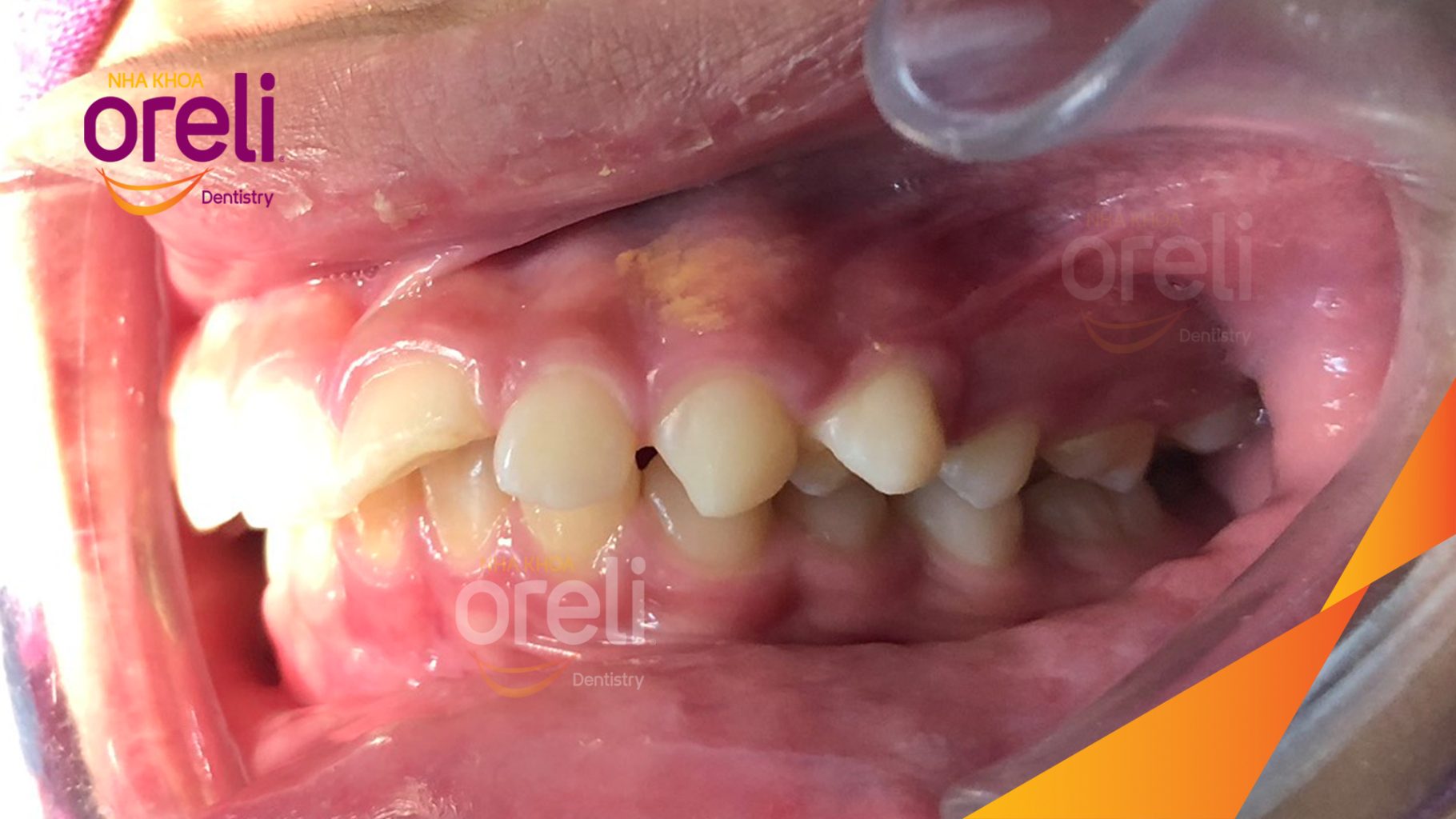 Trước điều trị: Răng hô, khớp cắn sâu, cắn chéo vùng răng sau bên trái tại Nha khoa Oreli