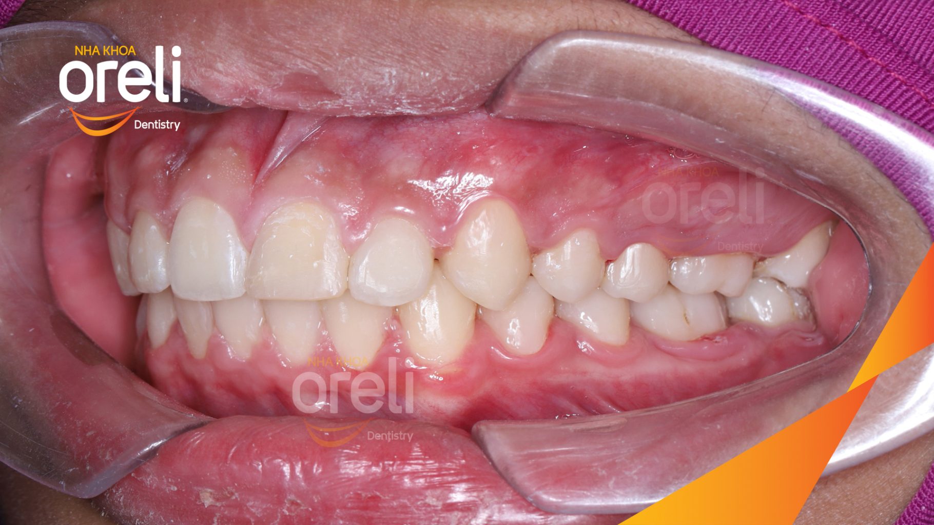Răng hô, khớp cắn sâu, cắn chéo vùng răng sau bên trái trước khi điều trị tại Nha khoa Oreli