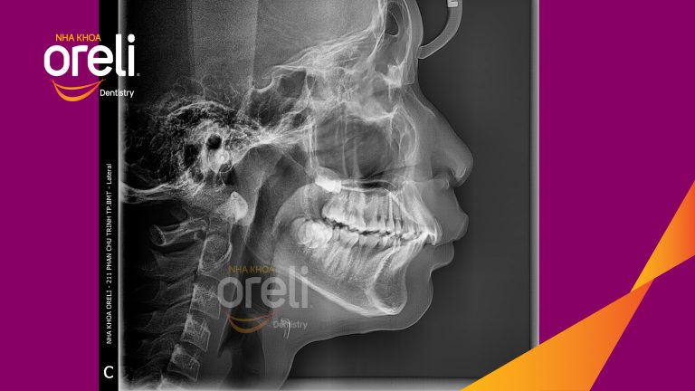 Niềng chỉnh hô không nhổ răng kết quả thực tế tại Oreli