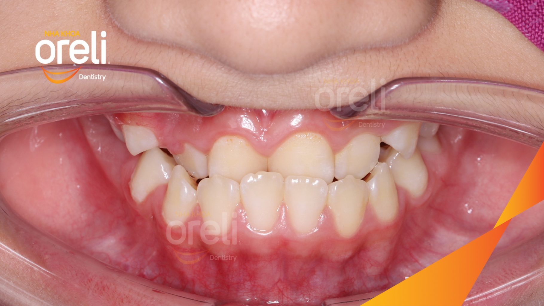 Kết quả sau 2 năm: Mặt nghiêng hết móm, khớp cắn đúng, nụ cười cải thiện rõ rệt tại Nha khoa Oreli Buôn Hồ