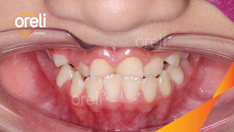Niềng răng móm lệch khớp không nhổ răng ở Buôn Hồ | Kết quả thực tế tại Nha khoa Oreli