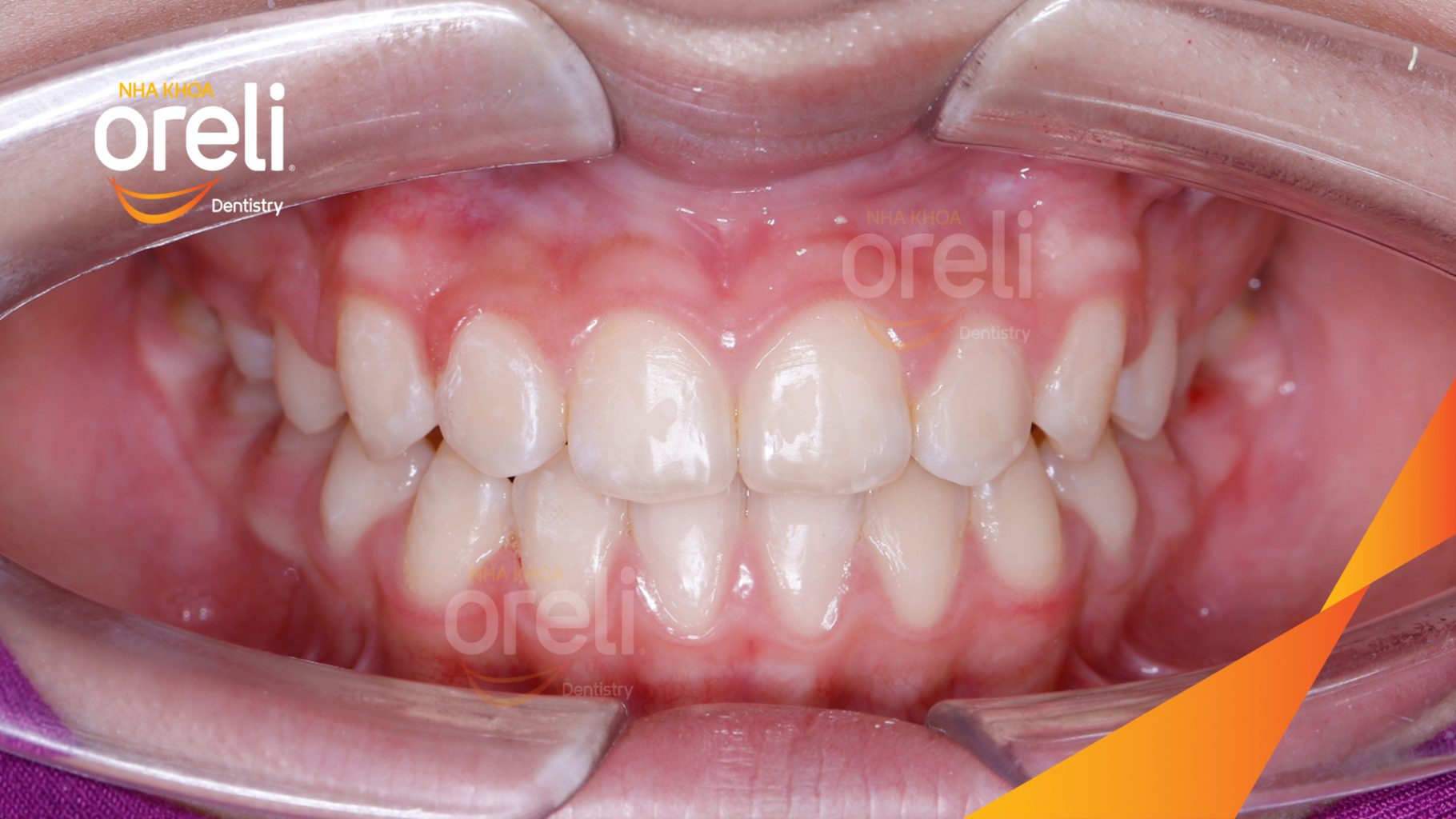 Kết quả đạt được sau 2 năm - Mặt nghiêng hết móm, khớp cắn đúng, nụ cười cải thiện rõ rệt tại Nha khoa Oreli Buôn Hồ