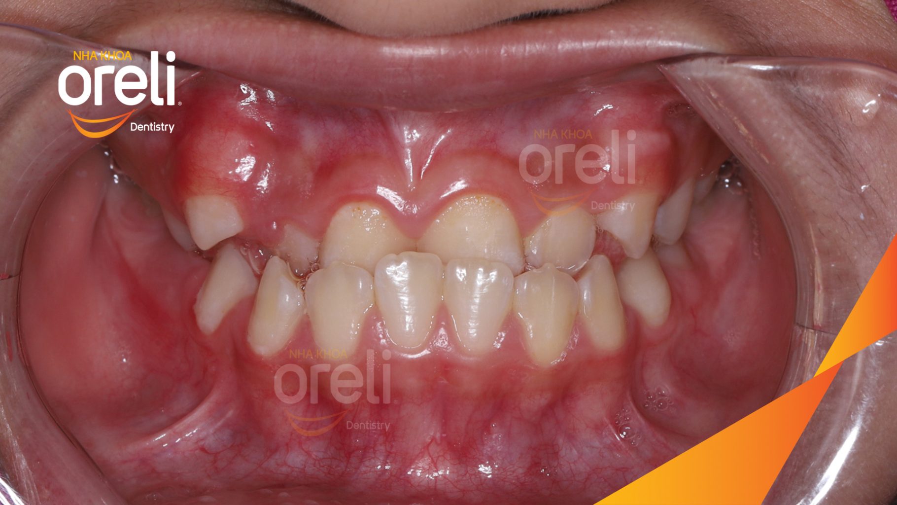 Quá trình Niềng răng không nhổ răng bằng mắc cài tự khóa trong 2 năm tại Nha khoa Oreli Buôn Hồ