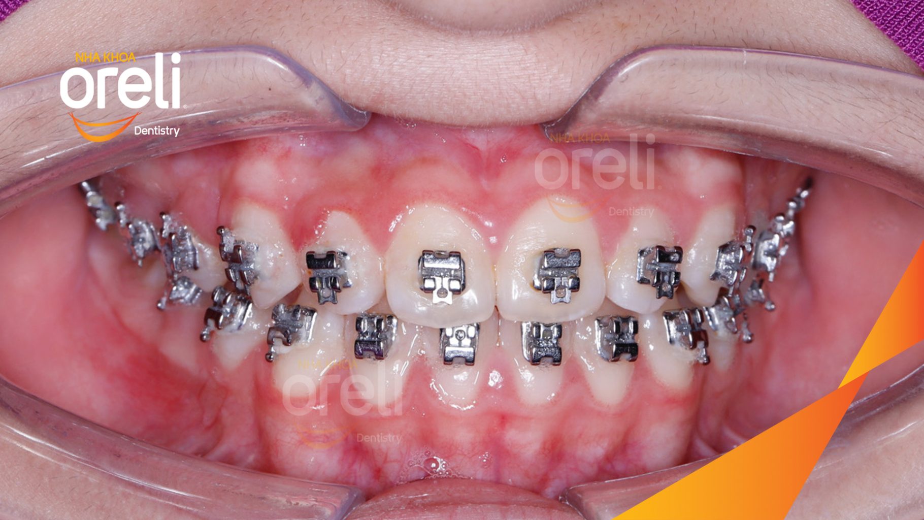 Thực hiện Niềng răng không nhổ răng bằng mắc cài tự khóa kéo dài 2 năm tại Nha khoa Oreli Buôn Hồ