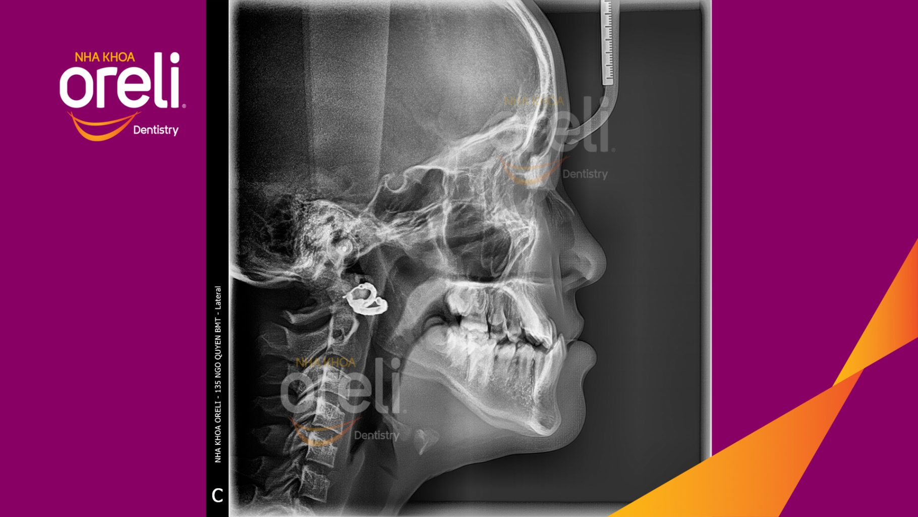 Trước điều trị: Sai khớp cắn hạng 3 cắn ngược vùng răng cửa, móm nặng tại Nha khoa Oreli Buôn Hồ