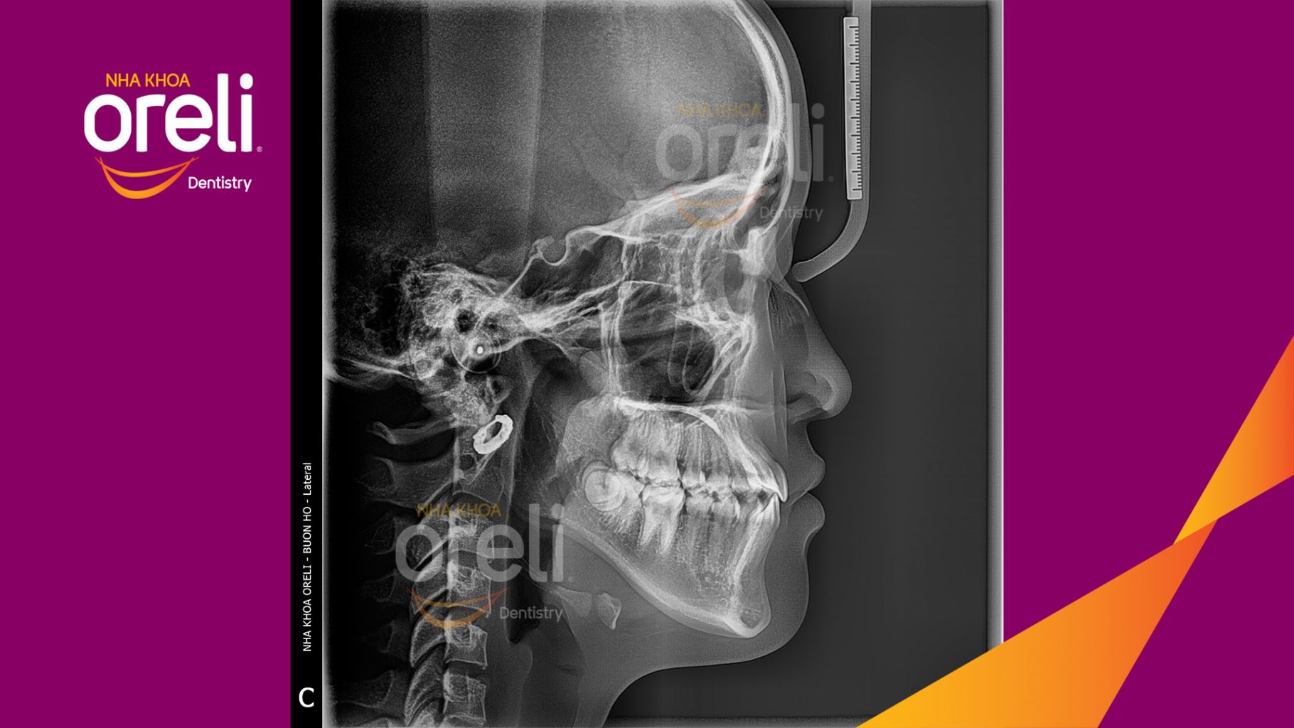 Sai khớp cắn hạng 3 cắn ngược vùng răng cửa, móm nặng trước khi điều trị tại Nha khoa Oreli Buôn Hồ