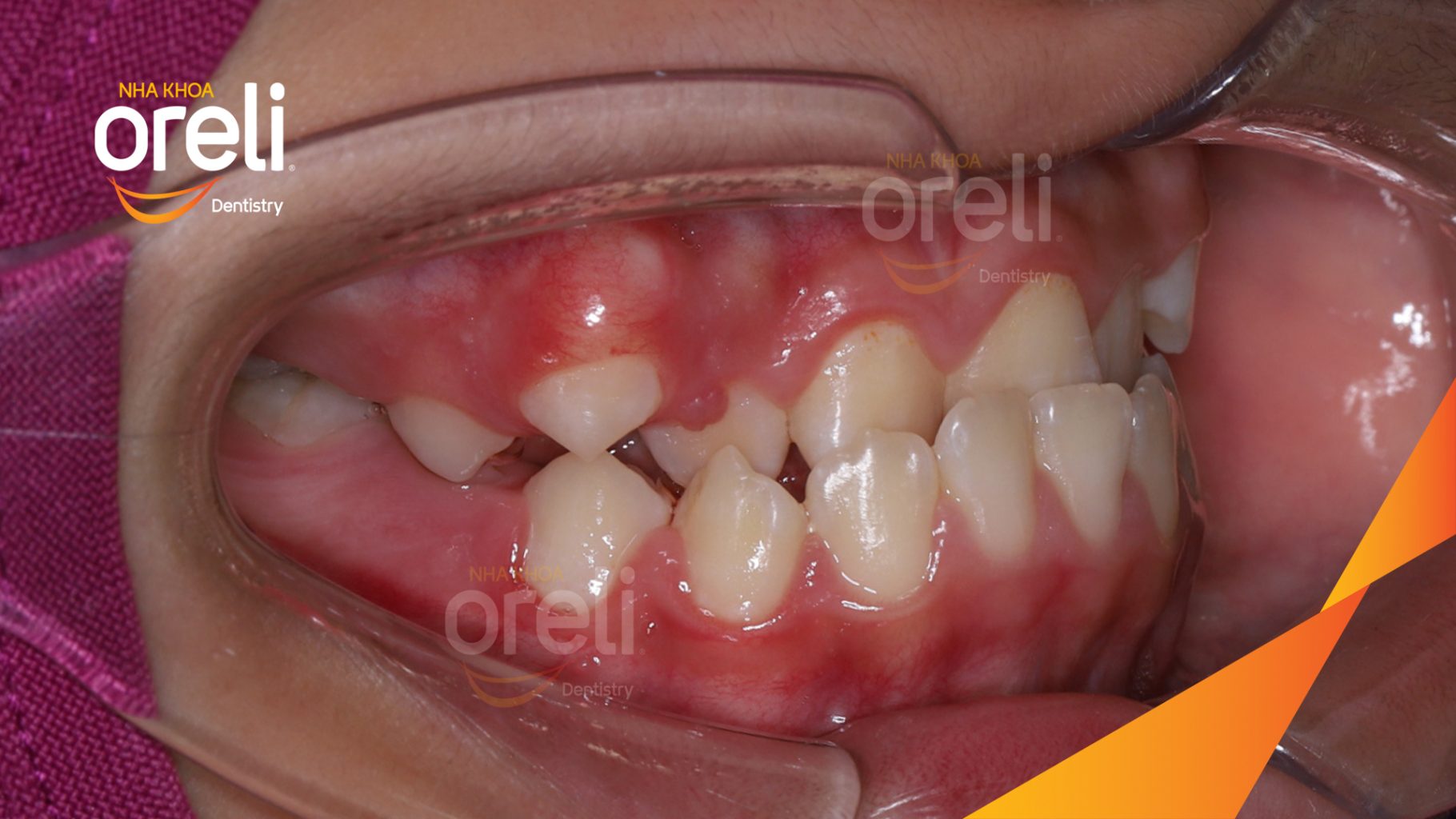 Trước điều trị: Sai khớp cắn hạng 3 cắn ngược vùng răng cửa, móm nặng tại Nha khoa Oreli Buôn Hồ