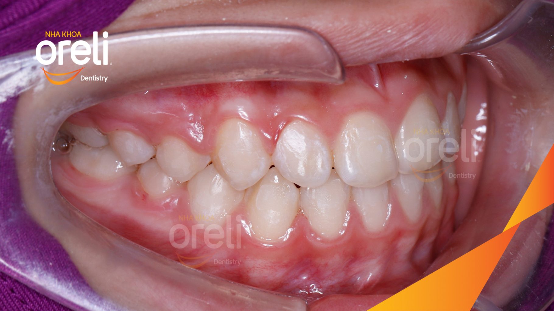 Sai khớp cắn hạng 3 cắn ngược vùng răng cửa, móm nặng trước khi điều trị tại Nha khoa Oreli Buôn Hồ