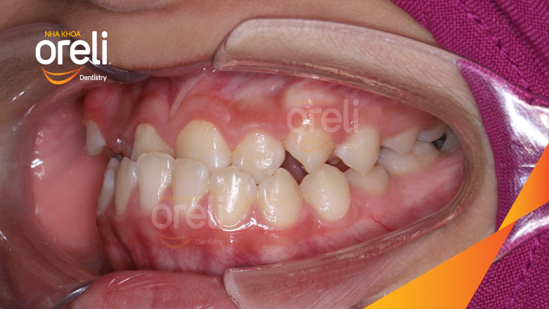 Quá trình Niềng răng không nhổ răng bằng mắc cài tự khóa trong 2 năm tại Nha khoa Oreli Buôn Hồ