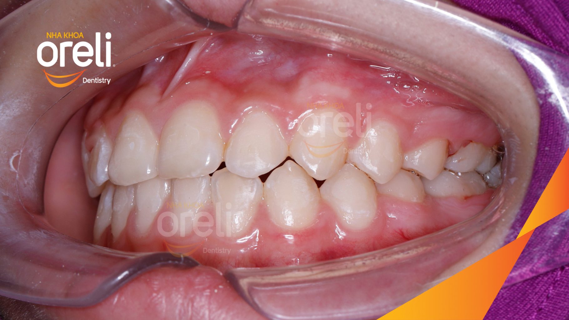 Thực hiện Niềng răng không nhổ răng bằng mắc cài tự khóa kéo dài 2 năm tại Nha khoa Oreli Buôn Hồ