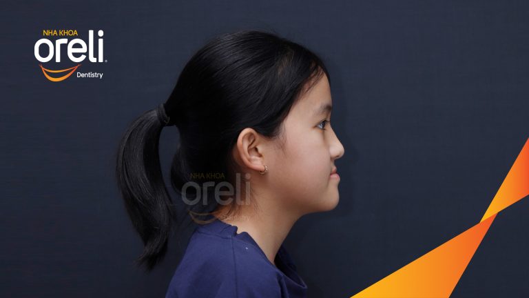 Niềng răng móm lệch khớp không nhổ răng ở Buôn Hồ | Kết quả thực tế tại Nha khoa Oreli