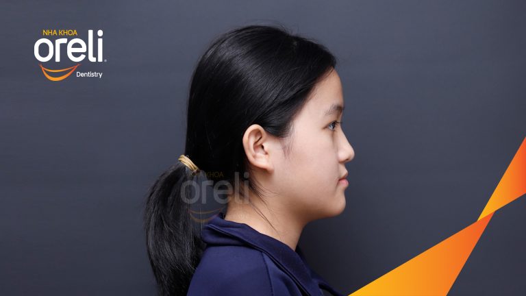 Niềng răng móm lệch khớp không nhổ răng ở Buôn Hồ | Kết quả thực tế tại Nha khoa Oreli