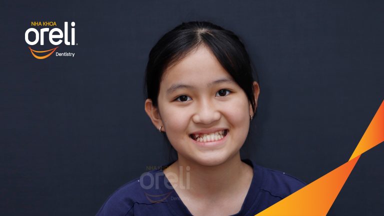 Niềng răng móm lệch khớp không nhổ răng ở Buôn Hồ | Kết quả thực tế tại Nha khoa Oreli