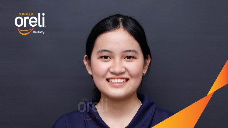 Niềng răng móm lệch khớp không nhổ răng ở Buôn Hồ | Kết quả thực tế tại Nha khoa Oreli