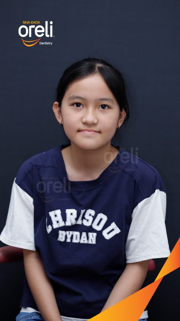 Kết quả sau 2 năm: Mặt nghiêng hết móm, khớp cắn đúng, nụ cười cải thiện rõ rệt tại Nha khoa Oreli Buôn Hồ
