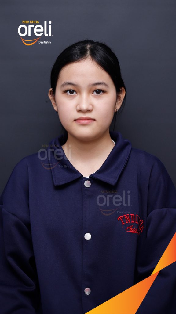 Kết quả đạt được sau 2 năm - Mặt nghiêng hết móm, khớp cắn đúng, nụ cười cải thiện rõ rệt tại Nha khoa Oreli Buôn Hồ