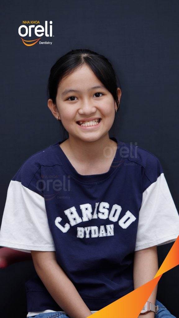 Trước điều trị: Sai khớp cắn hạng 3 cắn ngược vùng răng cửa, móm nặng tại Nha khoa Oreli Buôn Hồ