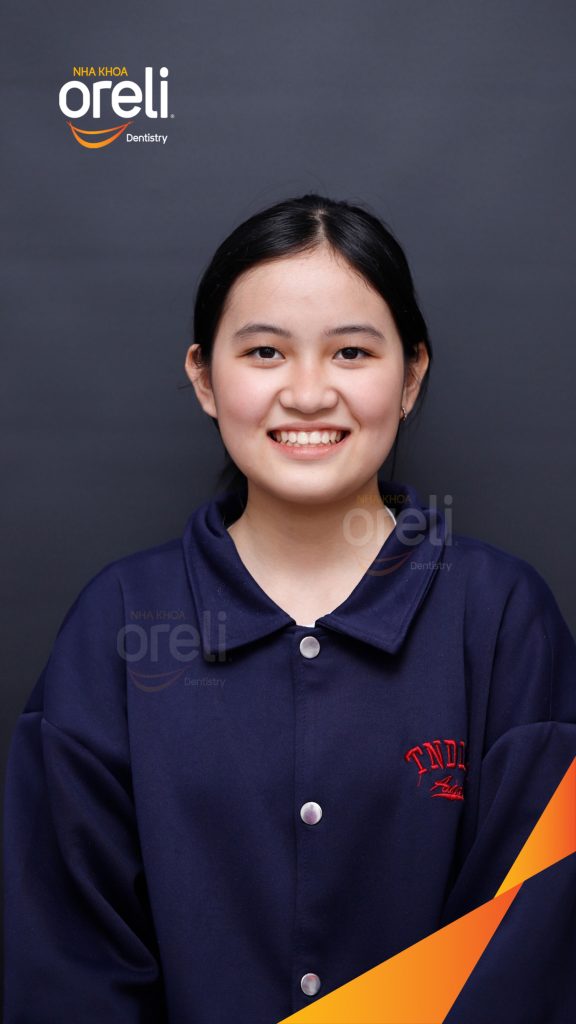 Sai khớp cắn hạng 3 cắn ngược vùng răng cửa, móm nặng trước khi điều trị tại Nha khoa Oreli Buôn Hồ