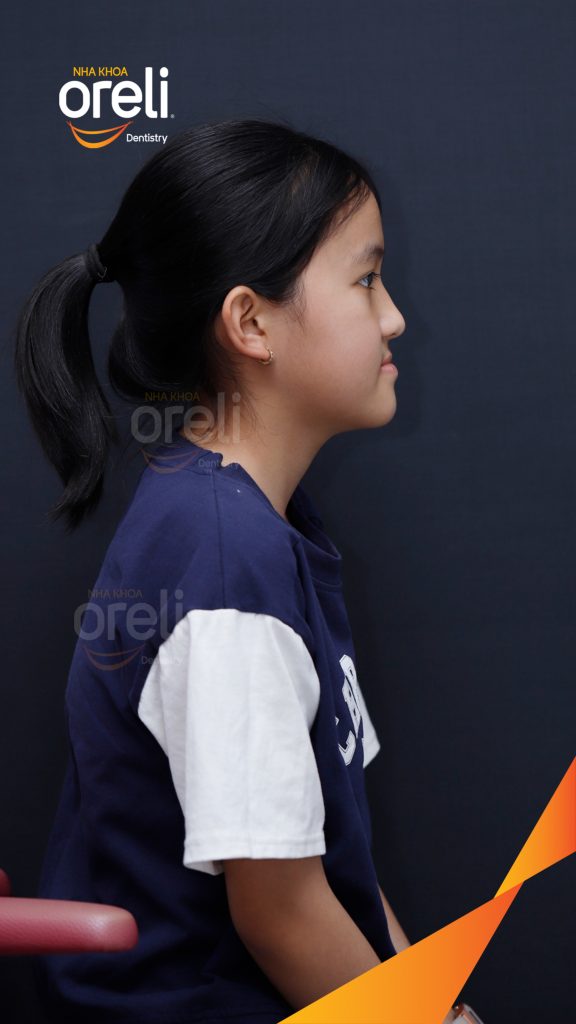 Quá trình Niềng răng không nhổ răng bằng mắc cài tự khóa trong 2 năm tại Nha khoa Oreli Buôn Hồ