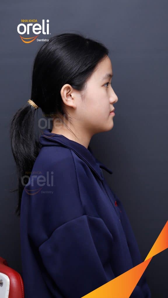 Thực hiện Niềng răng không nhổ răng bằng mắc cài tự khóa kéo dài 2 năm tại Nha khoa Oreli Buôn Hồ