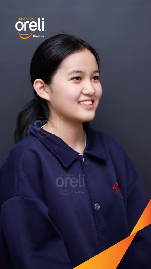 Kết quả đạt được sau 2 năm - Mặt nghiêng hết móm, khớp cắn đúng, nụ cười cải thiện rõ rệt tại Nha khoa Oreli Buôn Hồ
