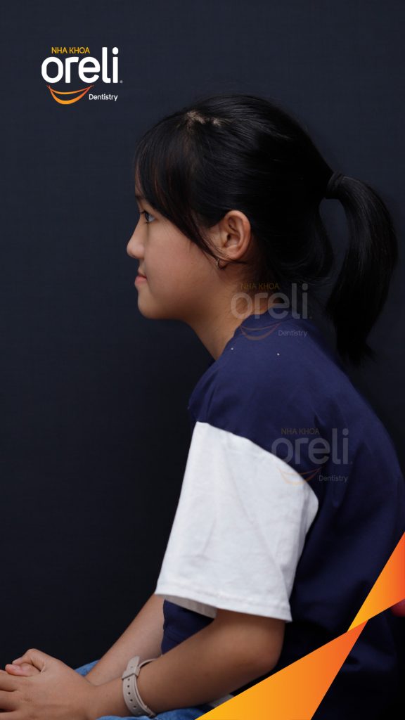 Trước điều trị: Sai khớp cắn hạng 3 cắn ngược vùng răng cửa, móm nặng tại Nha khoa Oreli Buôn Hồ