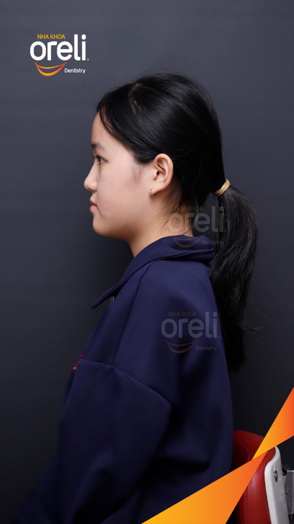 Sai khớp cắn hạng 3 cắn ngược vùng răng cửa, móm nặng trước khi điều trị tại Nha khoa Oreli Buôn Hồ