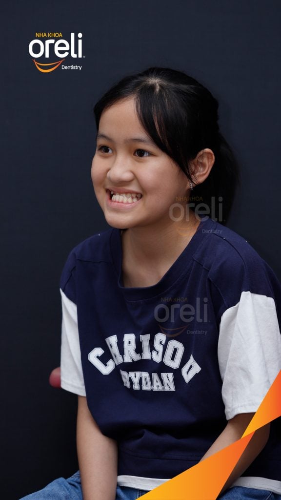 Quá trình Niềng răng không nhổ răng bằng mắc cài tự khóa trong 2 năm tại Nha khoa Oreli Buôn Hồ