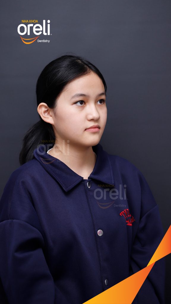 Kết quả sau 2 năm: Mặt nghiêng hết móm, khớp cắn đúng, nụ cười cải thiện rõ rệt tại Nha khoa Oreli Buôn Hồ