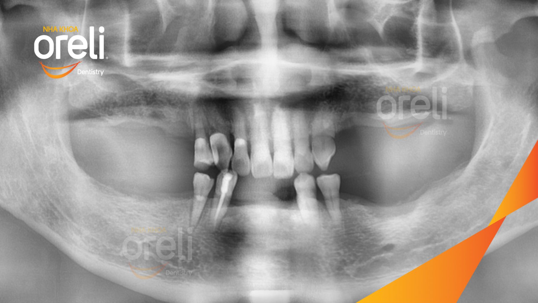 Trước điều trị: Mất răng nhai vùng hàm trên và dưới  tại Nha khoa Oreli Buôn Ma Thuột