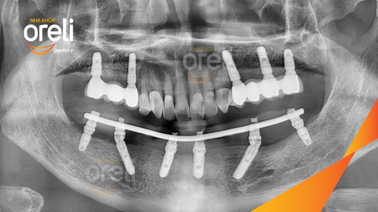 Trồng răng implant hàm dưới phục hồi nhai | Ca thực tế tại Oreli